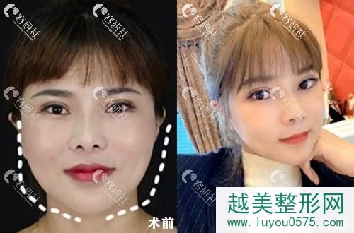 上海伊莱美李湘原磨骨瘦脸术前术后对比照