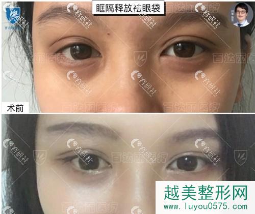 北京百达丽医疗美容门诊部祛眼袋前后对比