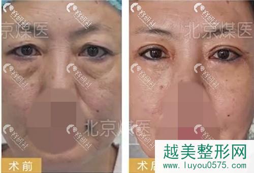 北京煤医医疗美容医院外切祛眼袋手术前后对比