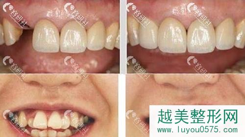 北京瑞泰口腔医院种植牙案例