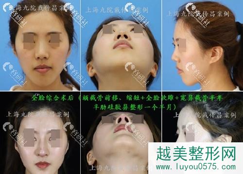 上海九院戴传昌隆鼻术前术后对比