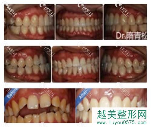 北京合生口腔隋青松医生牙齿矫正案例分享