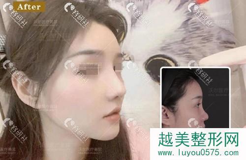北京沃尔医疗美容刘彦军肋软骨鼻修复前后对比照片