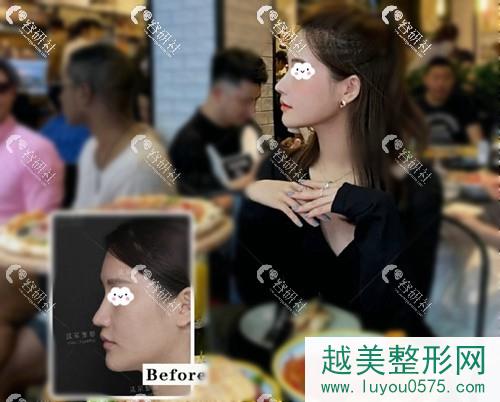 北京沃尔医疗美容刘彦军鼻修复+鼻基底填充案例