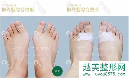 北京煤医医疗美容医院马桂文大脚骨矫正前后对比图