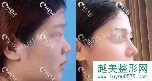 杭州美莱医疗美容鼻部手术案例