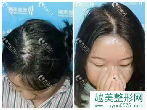 徐州雍禾发缝加密种植案例分享