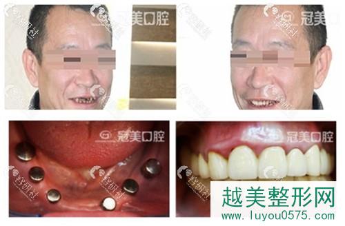 北京冠美口腔医院种植牙案例分享
