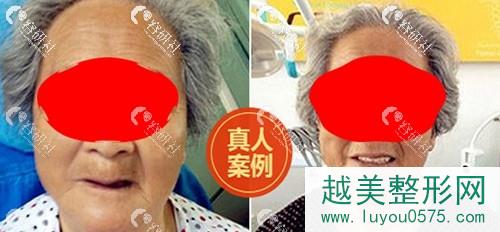 北京中诺口腔医院种植牙案例