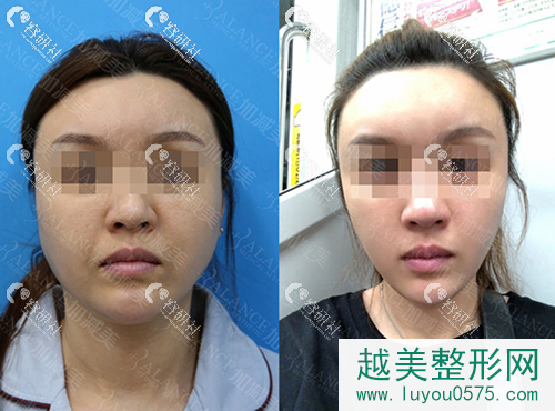 北京加减美面部提升案例