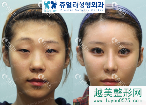 韩国珠儿丽医院割双眼皮案例