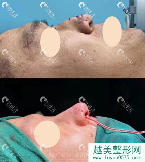 上海联合丽格范荣杰膨体鼻修复术后果