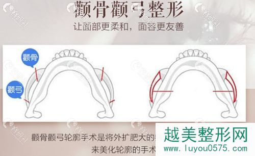 上海愉悦美联臣颧骨颧弓整形示意图