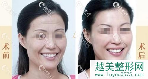 广州中家医家庭医生黄广香拉皮手术前后对比图