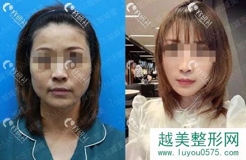 北京加减美穆宝安面部提升真人案例