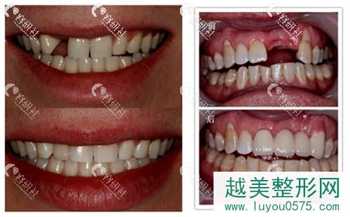 上海种植牙好的医院牙齿种植案例对比图