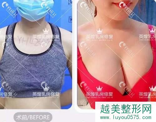 北京英煌梁耀婵自体脂肪隆胸案例
