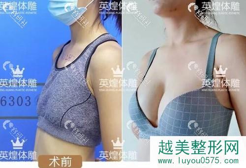 北京英煌梁耀婵自体脂肪隆胸前后对比图