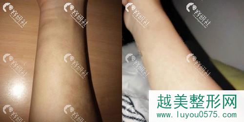 武汉同济医院整形美容科疤痕修复案例