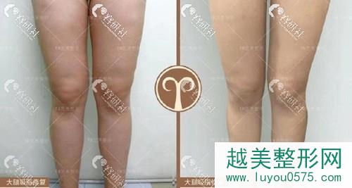 北京艺美王东大腿吸脂修复案例
