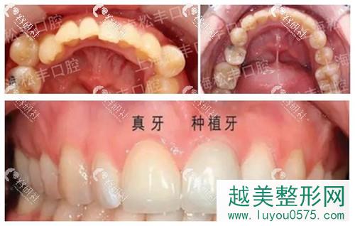 上海松丰齿科种植牙和牙齿矫正案例分享