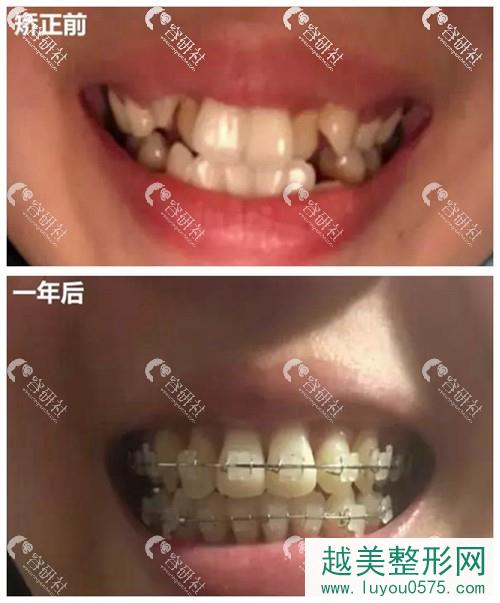 上海维佳康口腔医院牙齿矫正一年前后对比