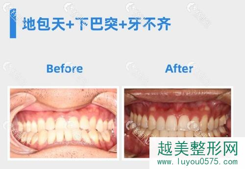北京禾禾齿科地包天牙齿不齐正畸前后果对比