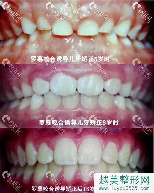 罗慕咬合诱导治疗8-18岁的牙齿生长情况