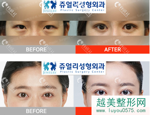 韩国珠儿丽医院割双眼皮案例