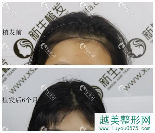 深圳新生植发医院发际线种植六个月果分享