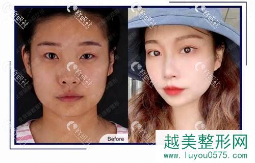 北京丽都医疗美容割8度美瞳术真实案例