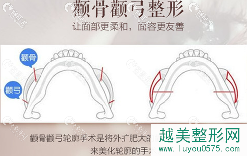上海愉悦美联臣颧骨颧弓整形方法
