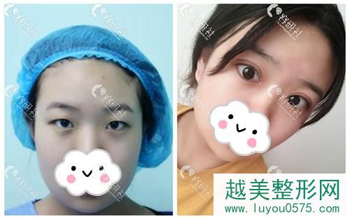 天津联合丽格双眼皮手术案例