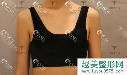 北京润美玉之光自体脂肪隆胸术前照片