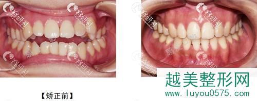 广州鹏爱口腔医院开颌牙齿矫正前后对比图