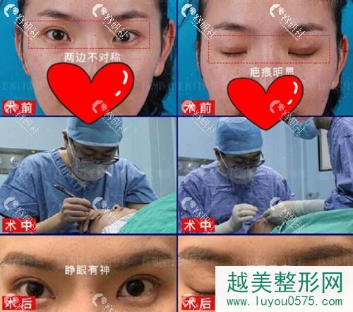 南京医科大学友谊整形外科割双眼皮真人案例