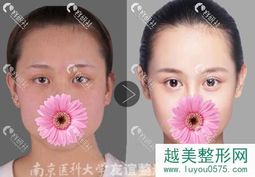 南京医科大学友谊整形外科割双眼皮案例果图