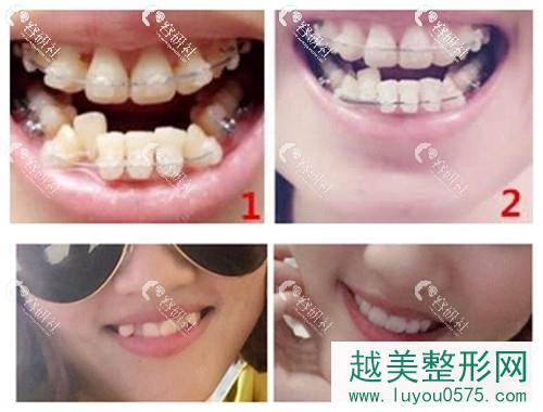 重庆成佳牙博士口腔医院牙齿矫正案例分享