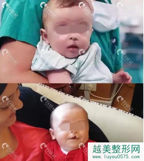 上海薇琳整形修复外科中心唇腭裂修复案例