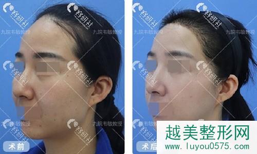 上海九院韦敏下颌角手术案例