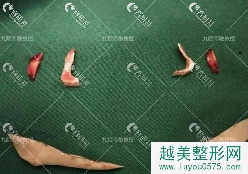 上海九院韦敏教授手术中切割下来的下颌角