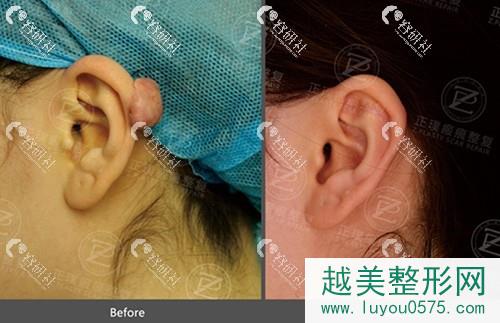 武汉正璞医疗美容门诊部耳朵疙瘩疤痕修复案例
