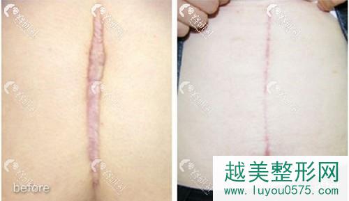 上海清沁医疗美容门诊部剖腹产修复案例