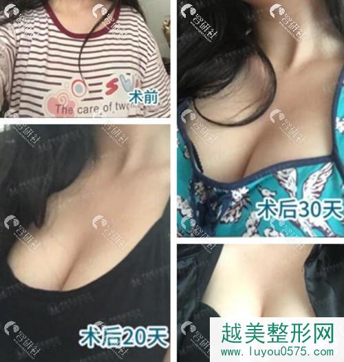 广州中家医家庭医生黄广香隆胸前后对比图