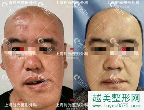 上海时光何晋龙正颌术前术后对比图