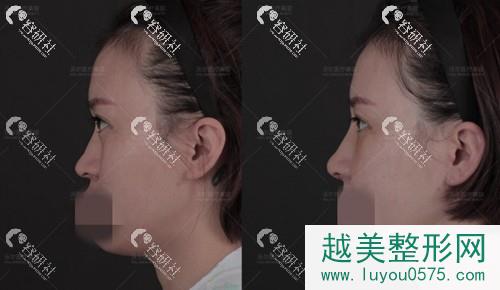 北京沃尔整形汪垟医生隆鼻案例