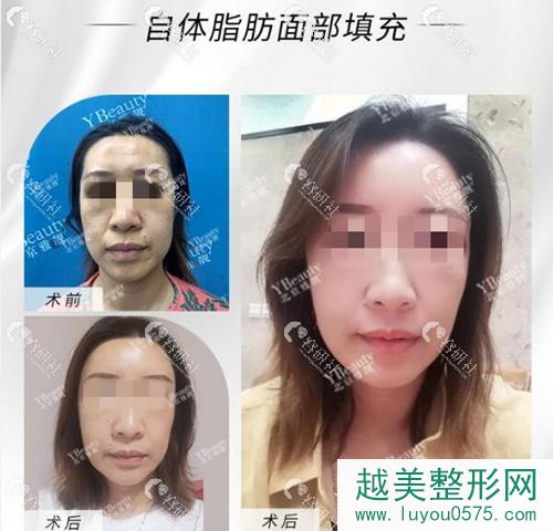 北京雅靓张春彦面部脂肪填充术前术后对比图