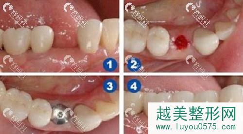 拔牙后种牙全过程案例展示