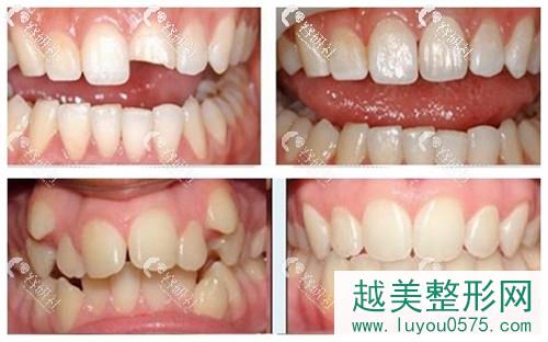 西安欢乐口腔牙齿修复和牙齿矫正案例分享