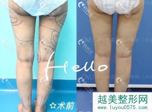 深圳曹孟君医疗美容门诊部大腿环吸前后对比照片